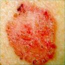 Squamous Cell Carcinoma